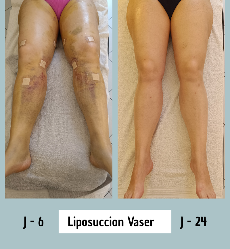 Elena Martinez.Kiné.Ostéo.Esthétique.Drainage lymphatique post-op,abdominoplastie,liposuccion,lifting,cicatrices
